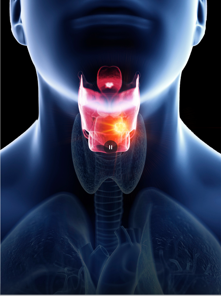 Learn more about Laryngeal Cancer Diagnosis & Treatment with Dr. Yash ...